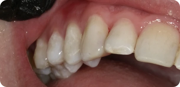 Bonding example, after treatment: close view of the front tooth
