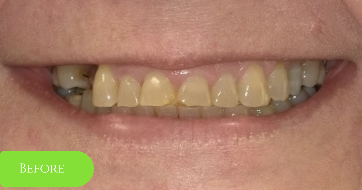 Full smile makeover example, before treatment: teeth shown while smiling