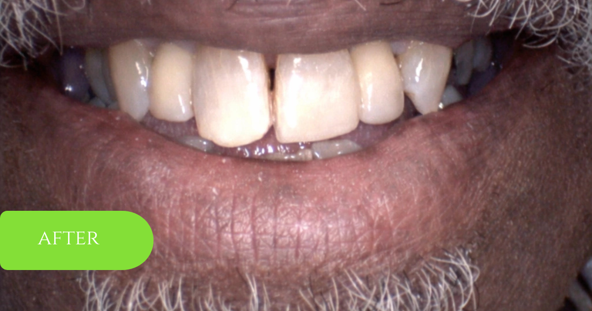 Restorative smile repair example, after treatment: front teeth shown while smiling