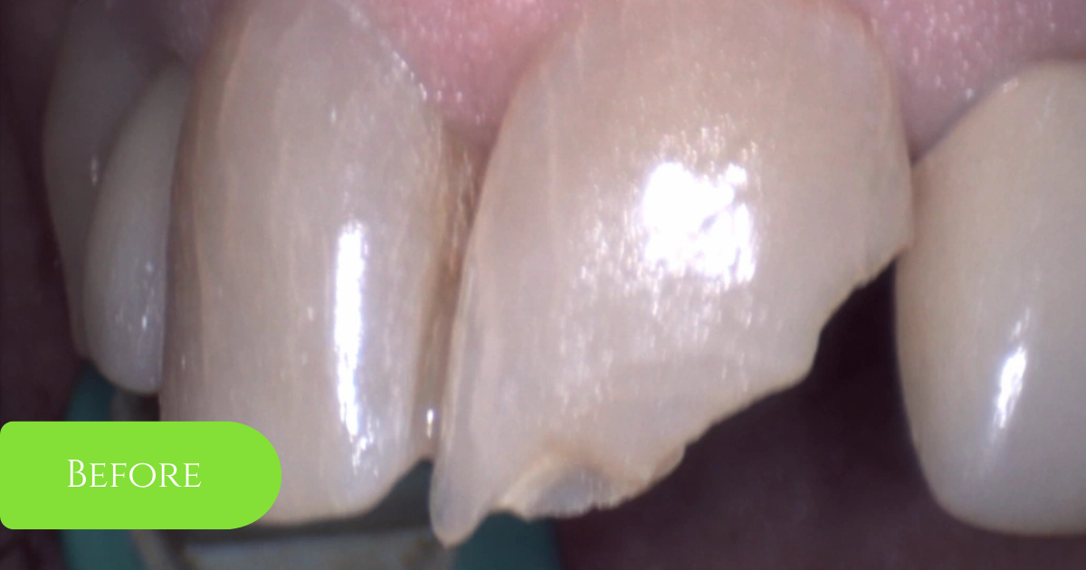 Restorative smile repair example, before treatment: close view of a chipped front tooth